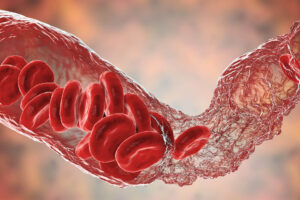 blood clot formation - illustration